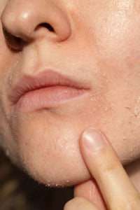 Blemishes and Pigmentation